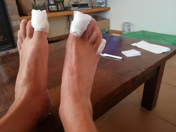 Esta imagen resume a la perfección la dureza de la prueba. Uno de los corredores perdió dos uñas de los pies.